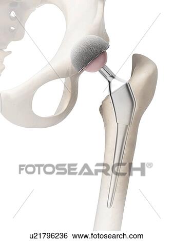 Stock Illustration - Human hip replacement, artwork. Fotosearch