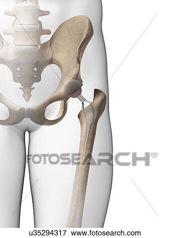 Human hip replacement, artwork View Large Illustration Stock Illustration - Human hip replacement, artwork. Fotosearch