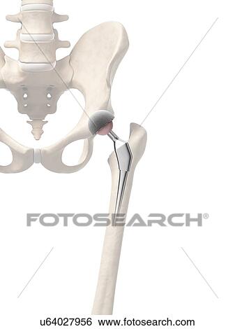 Stock Illustration - Human hip replacement, artwork. Fotosearch