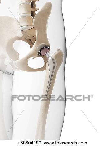 Stock Illustration - Human hip replacement, artwork. Fotosearch