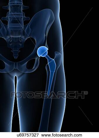 Stock Illustration - Human hip replacement, artwork. Fotosearch