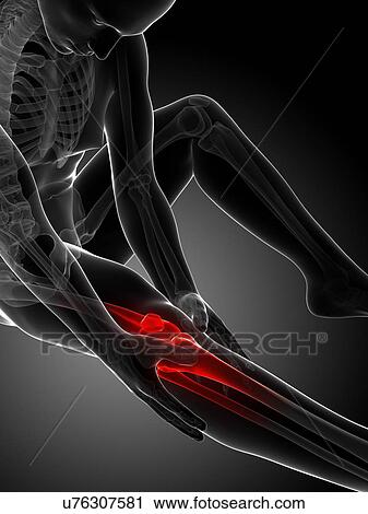 Human knee pain, artwork View Large Illustration Clip Art - Human knee pain, artwork. Fotosearch
