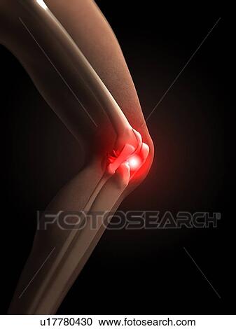 Clipart - Human knee pain, artwork. Fotosearch
