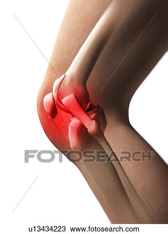 Human knee pain, artwork View Large Illustration Drawing - Human knee pain, artwork. Fotosearch