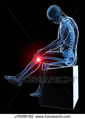 Human knee pain, artwork View Large Illustration Drawing - Human knee pain, artwork. Fotosearch