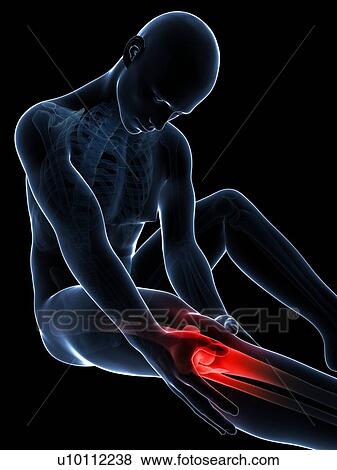 Human knee pain, artwork View Large Illustration Stock Illustration - Human knee pain, artwork. Fotosearch