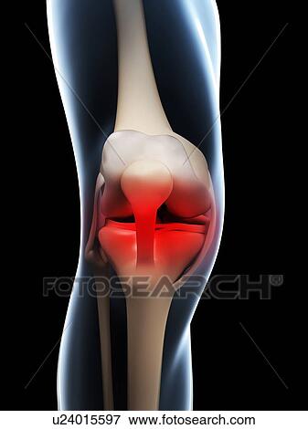 Stock Illustration - Human knee pain, artwork. Fotosearch
