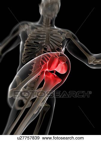 Human knee pain, artwork View Large Illustration Stock Illustration - Human knee pain, artwork. Fotosearch