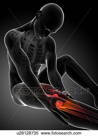 Human knee pain, artwork View Large Illustration Stock Illustration - Human knee pain, artwork. Fotosearch