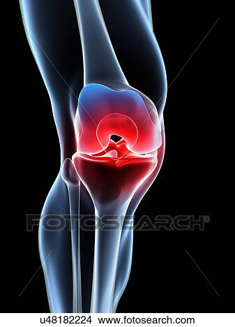 Stock Illustration - Human knee pain, artwork. Fotosearch