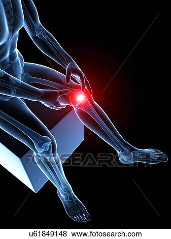 Stock Illustration - Human knee pain, artwork. Fotosearch