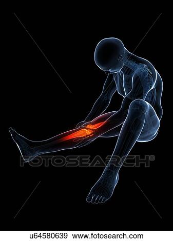 Human knee pain, artwork View Large Illustration Stock Illustration - Human knee pain, artwork. Fotosearch