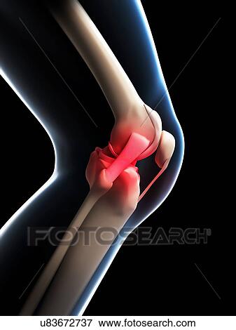 Human knee pain, artwork View Large Illustration Stock Illustration - Human knee pain, artwork. Fotosearch
