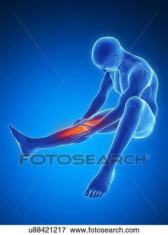 Stock Illustration - Human knee pain, artwork. Fotosearch