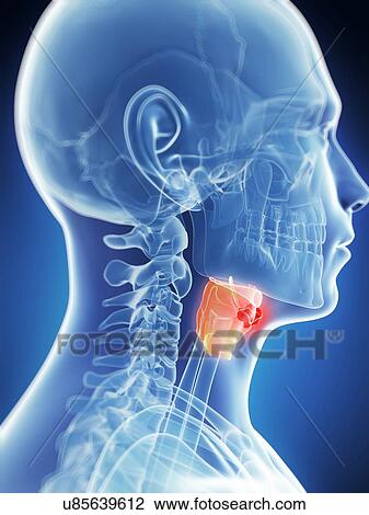 Drawing - Human larynx tumor, artwork. Fotosearch