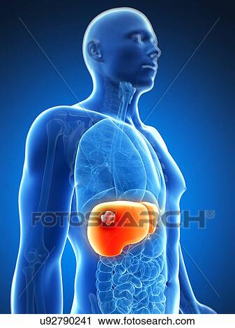 Human liver cancer, artwork View Large Illustration Clip Art - Human liver cancer, artwork. Fotosearch