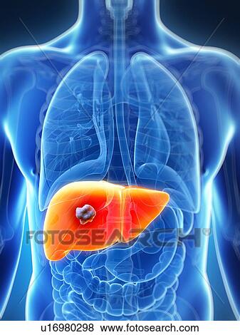 Human liver cancer, artwork View Large Illustration Stock Illustration - Human liver cancer, artwork. Fotosearch