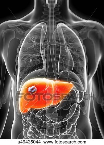 Stock Illustration - Human liver cancer, artwork. Fotosearch