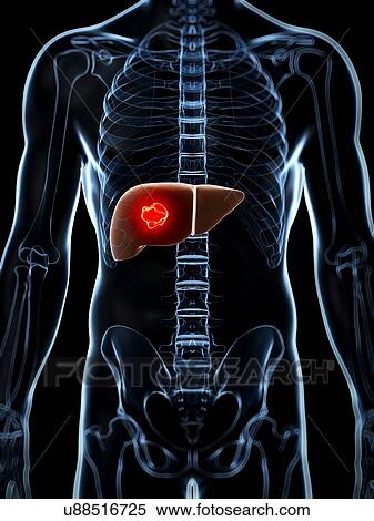Human liver cancer, artwork View Large Illustration Stock Illustration - Human liver cancer, artwork. Fotosearch