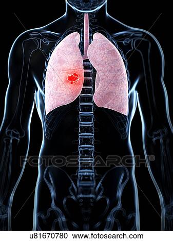 Human lung cancer, artwork View Large Illustration Clipart - Human lung cancer, artwork. Fotosearch