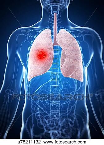 Human lung cancer, artwork View Large Illustration Drawing - Human lung cancer, artwork. Fotosearch