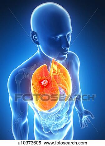 Human lung cancer, artwork View Large Illustration Stock Illustration - Human lung cancer, artwork. Fotosearch