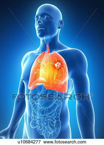 Human lung cancer, artwork View Large Illustration Stock Illustration - Human lung cancer, artwork. Fotosearch