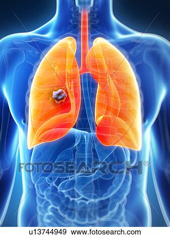 Stock Illustration - Human lung cancer, artwork. Fotosearch
