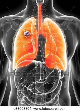 Human lung cancer, artwork View Large Illustration Stock Illustration - Human lung cancer, artwork. Fotosearch