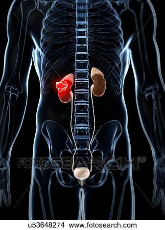 Male kidney cancer, artwork View Large Illustration Stock Illustration - Male kidney cancer, artwork. Fotosearch