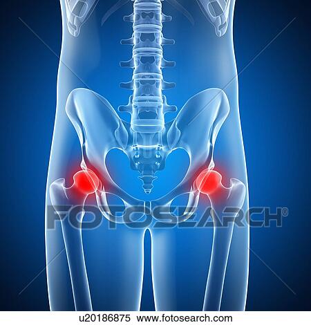 Stock Illustration - Painful human hip joints, artwork. Fotosearch