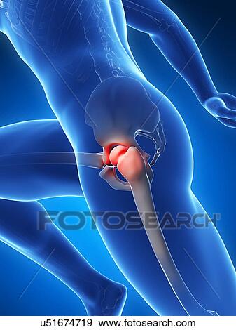 Painful human hip joints, artwork View Large Illustration Stock Illustration - Painful human hip joints, artwork. Fotosearch