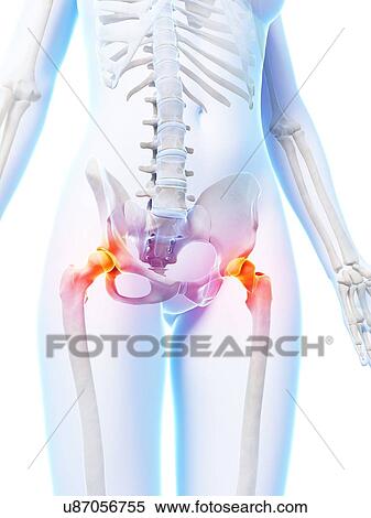 Stock Illustration - Painful human hip joints, artwork. Fotosearch