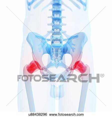 Painful human hip joints, artwork View Large Illustration Stock Illustration - Painful human hip joints, artwork. Fotosearch