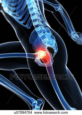 Runner's hip joint, artwork View Large Illustration Stock Illustration - Runner's hip joint, artwork. Fotosearch