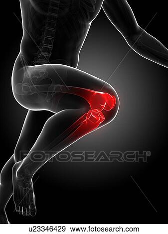 Stock Illustration - Runner's knee joint, artwork. Fotosearch