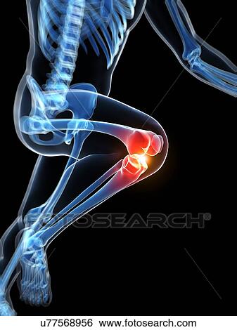Runner's knee joint, artwork View Large Illustration Stock Illustration - Runner's knee joint, artwork. Fotosearch