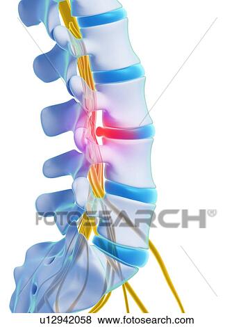 Slipped disc, artwork View Large Illustration Stock Illustration - Slipped disc, artwork. Fotosearch