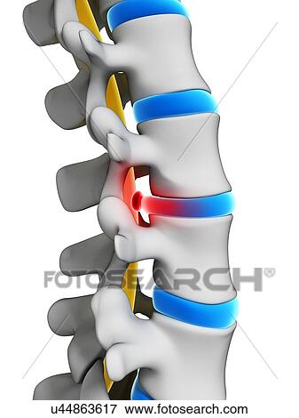 Slipped disc, artwork View Large Illustration Stock Illustration - Slipped disc, artwork. Fotosearch