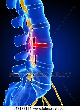 Stock Illustration - Slipped disc, artwork. Fotosearch