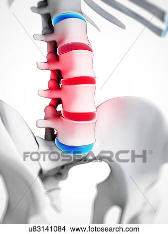 Slipped disc, artwork View Large Illustration Stock Illustration - Slipped disc, artwork. Fotosearch