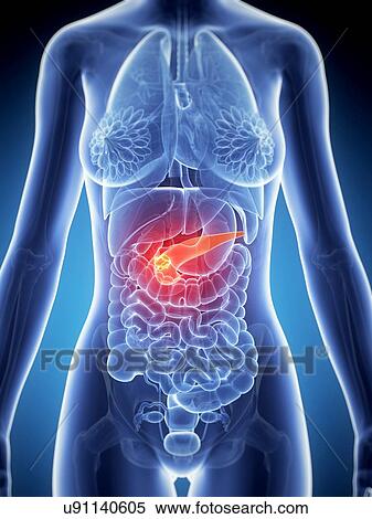 Stock Illustration - Female pancreas showing tumor, artwork. Fotosearch