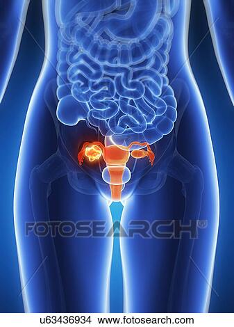 Female uterus with tumor, artwork View Large Illustration Stock Illustration - Female uterus with tumor, artwork. Fotosearch
