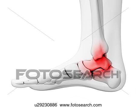 Stock Illustration - Human ankle pain, artwork. Fotosearch