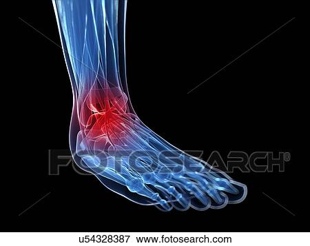 Human ankle pain, artwork View Large Illustration Stock Illustration - Human ankle pain, artwork. Fotosearch