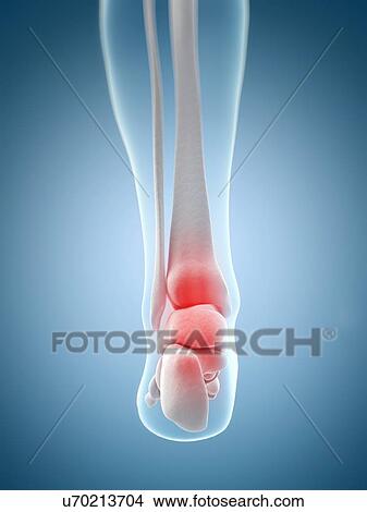 Human ankle pain, artwork View Large Illustration Stock Illustration - Human ankle pain, artwork. Fotosearch