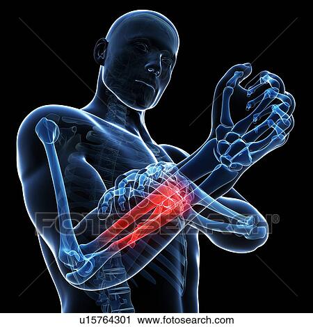 Clip Art - Human arm pain, artwork. Fotosearch