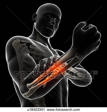 Clip Art - Human arm pain, artwork. Fotosearch