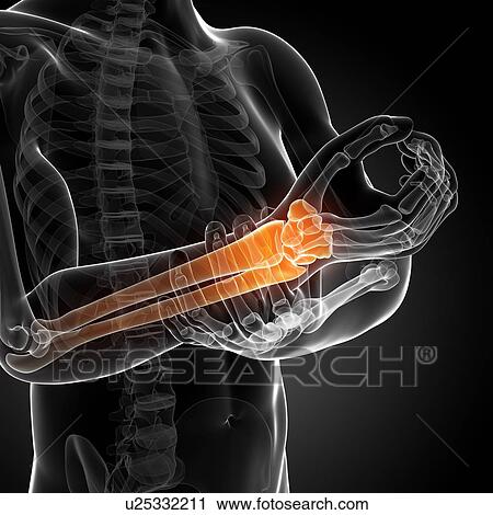 Clip Art - Human arm pain, artwork. Fotosearch