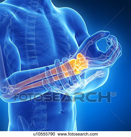 Human arm pain, artwork View Large Illustration Clipart - Human arm pain, artwork. Fotosearch